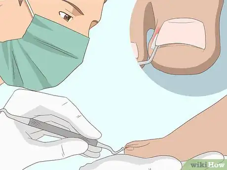 Image intitulée Relieve Ingrown Toe Nail Pain Step 24