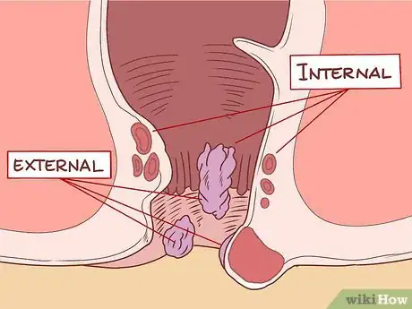 Image intitulée Care for Hemorrhoids Postpartum Step 26