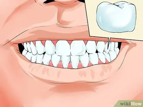 Image intitulée Avoid Dental Crown Problems Step 1