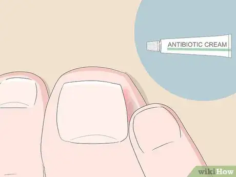 Image intitulée Relieve Ingrown Toe Nail Pain Step 10