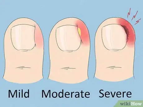 Image intitulée Will an Ingrown Toenail Heal Itself Step 1