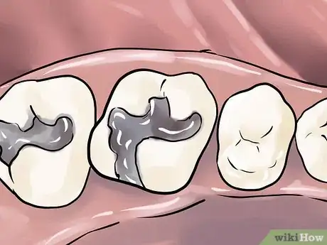 Image intitulée Get Rid of Tooth Pain Step 16