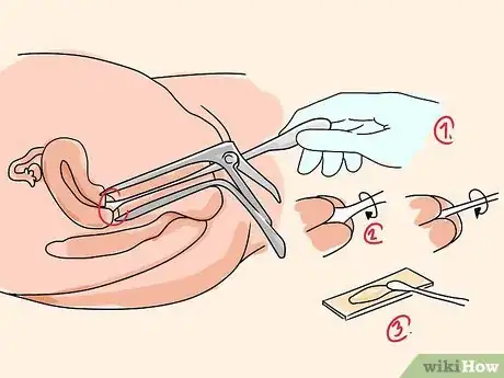Image intitulée Recognize Cervical Cancer Symptoms Step 9