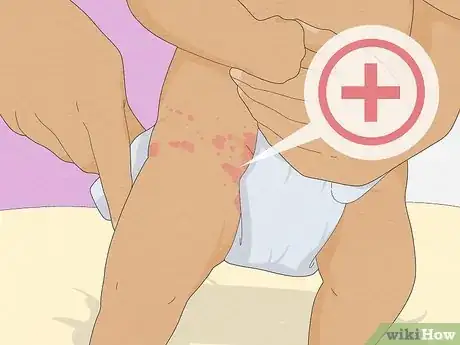 Image intitulée Treat Diaper Rash Step 5