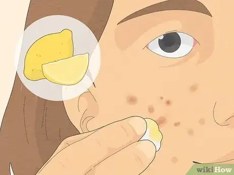 Image intitulée Get Rid of Cystic Acne Scars Step 2