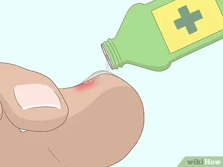 Image intitulée Relieve Ingrown Toe Nail Pain Step 16