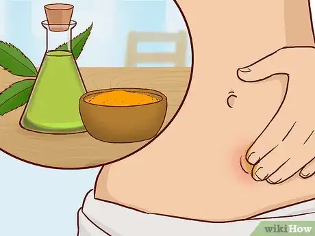 Image intitulée Cure Lipomas Naturally Step 3