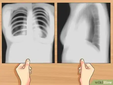 Image intitulée Read a Chest X Ray Step 8