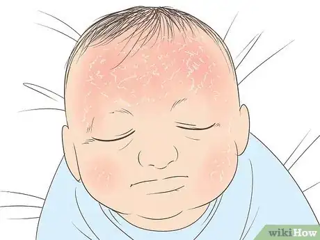 Image intitulée Know What to Expect on a Newborn's Skin Step 5