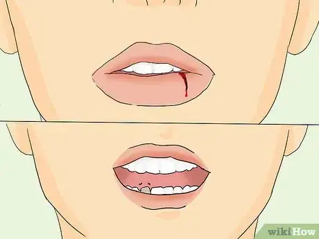 Image intitulée Heal a Swollen Lip Step 13