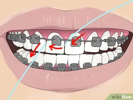 Image intitulée Floss With Braces Step 3