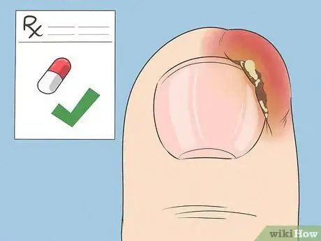 Image intitulée Will an Ingrown Toenail Heal Itself Step 9