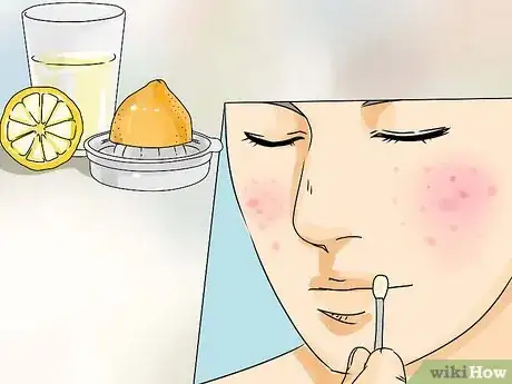 Image intitulée Get Rid of Pimples on a Tight Budget Step 10