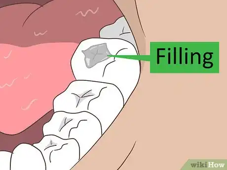 Image intitulée Treat Cavities Step 4