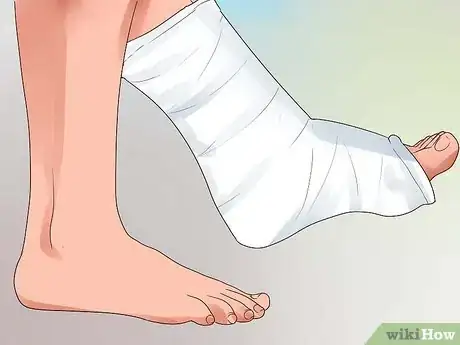 Image intitulée Heal a Broken Toe Step 10