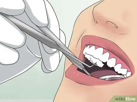 Image intitulée Clean Partially Erupted Wisdom Teeth Step 12