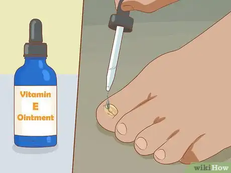 Image intitulée Help a Toenail Grow Back Quickly Step 11