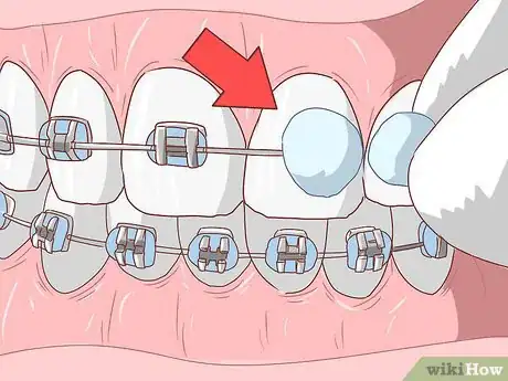 Image intitulée Avoid Pain When Your Braces Are Tightened Step 13