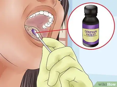 Image intitulée Treat Oral Thrush Step 4