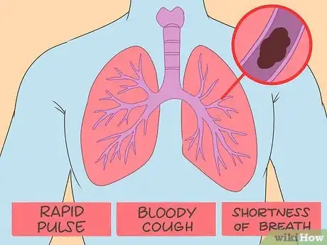 Image intitulée Dissolve Blood Clots Step 6