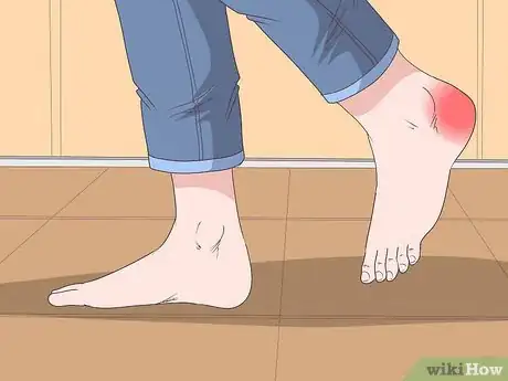 Image intitulée Treat a Heel Bruise Step 1