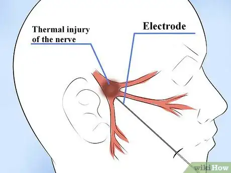 Image intitulée Alleviate Pain Caused by Trigeminal Neuralgia Step 10