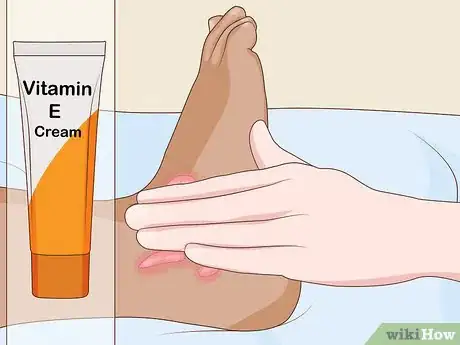 Image intitulée Get Rid of Keloids Step 12