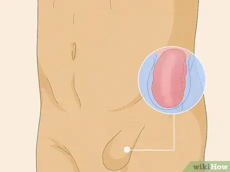 Image intitulée Treat Constipation After Hernia Surgery Step 13