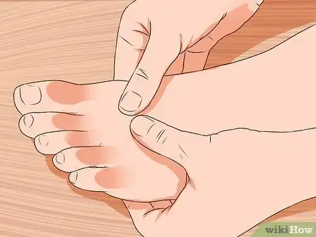 Image intitulée Relieve Bunions Step 7