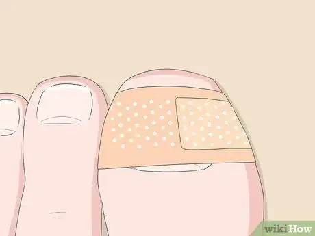 Image intitulée Relieve Ingrown Toe Nail Pain Step 11