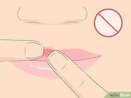 Image intitulée Get Rid of a Cold Sore Step 11