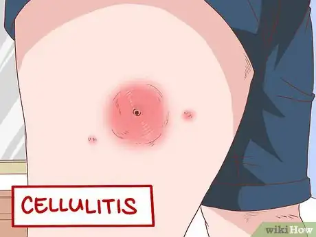 Image intitulée Identify Symptoms of MRSA Step 3