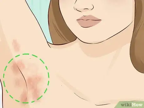 Image intitulée Treat a Yeast Infection on Your Skin Step 1.jpeg