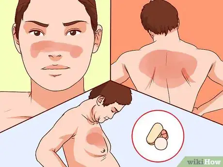 Image intitulée Diagnose Lupus Step 17