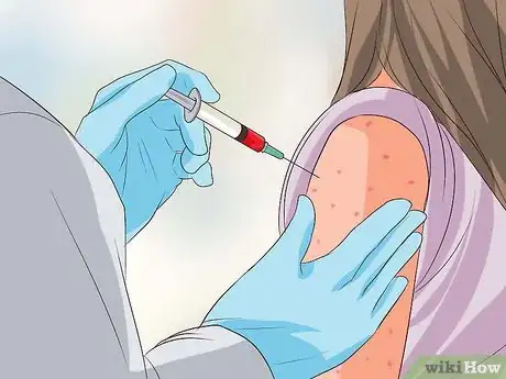 Image intitulée Recognize Chickenpox Step 14