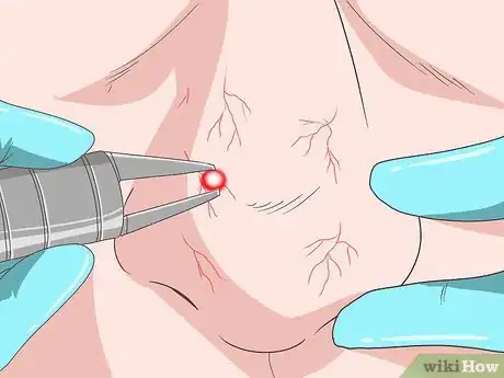 Image intitulée Get Rid of Spider Veins on Your Nose Step 10