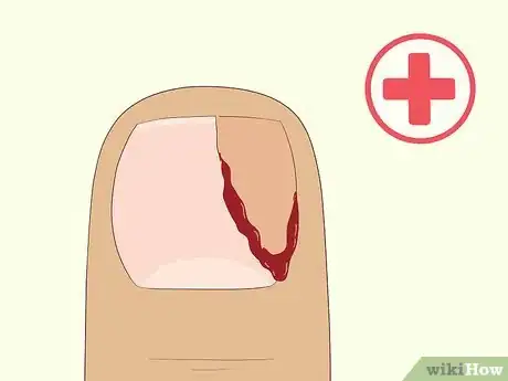 Image intitulée Heal Damaged Nails Step 5