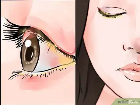 Image intitulée Treat Eye Infection Naturally Step 14