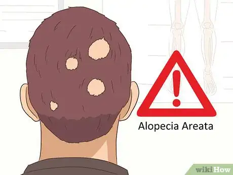 Image intitulée Treat Alopecia Step 12