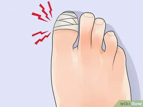 Image intitulée Treat a Stubbed Toe Step 9