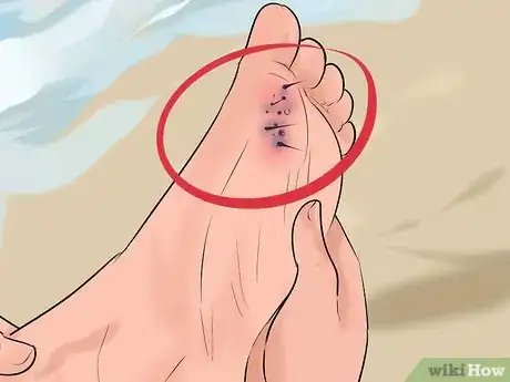 Image intitulée Identify and Treat Injuries From Stingrays and Sea Urchins Step 12