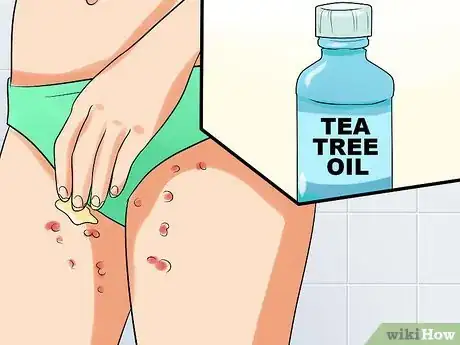 Image intitulée Ease Herpes Pain with Home Remedies Step 9