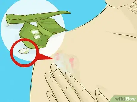 Image intitulée Use Aloe Vera to Treat Burns Step 7