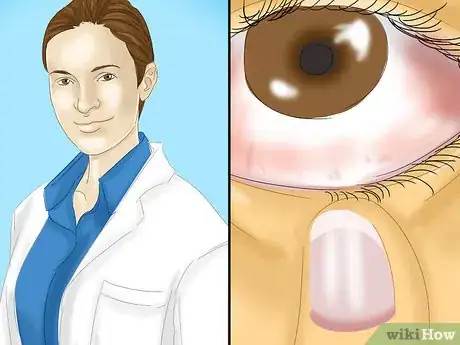 Image intitulée Get Dirt Out of Your Eye Step 10