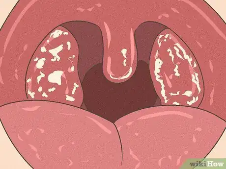 Image intitulée Differentiate Bacterial Tonsillitis and Viral Tonsillitis Step 7