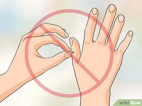 Image intitulée Get Rid of Warts on Fingers Step 10