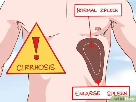Image intitulée Recognize Cirrhosis Step 20
