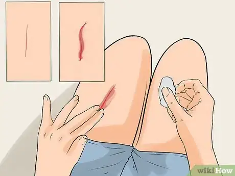 Image intitulée Determine if a Cut Needs Stitches Step 7