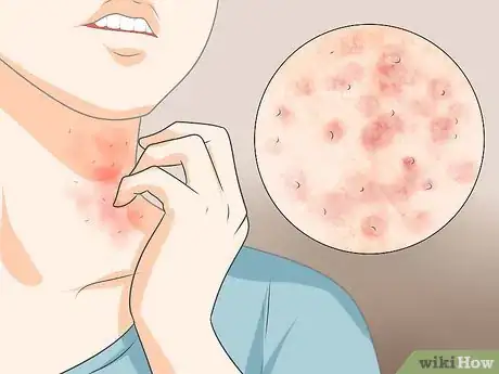 Image intitulée Recognize Scabies Rash Step 2