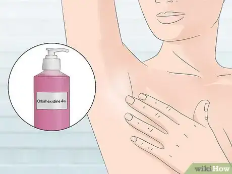 Image intitulée Stop Armpit Pimples Step 2